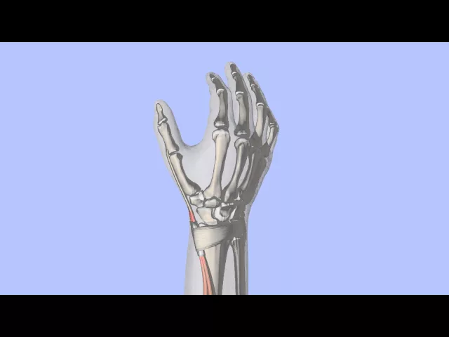 De Quervain's Tenosynovitis