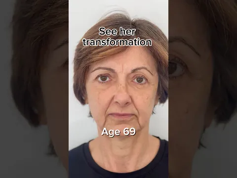 See her transformation | Face Fitness | Face Yoga | Face Massage