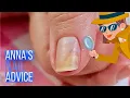 Download Lagu Nail Separation | Causes | Early Treatment of Onycholysis [Anna's Nail Advice]