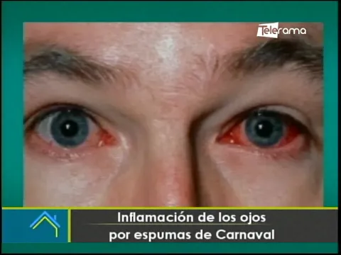 Inflamación de los ojos por espumas de carnaval