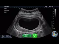 Kids Stomach Ultrasound Scan - Part 2 No worm what happens if you eat too much chocolate