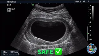 Kids Stomach Ultrasound Scan - Part 2 No worm what happens if you eat too much chocolate