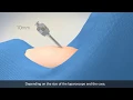 Abdominal entry In laparoscopic gynecologic surgery