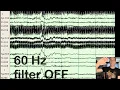 EEG Filters HFF LFF Notch Artifact