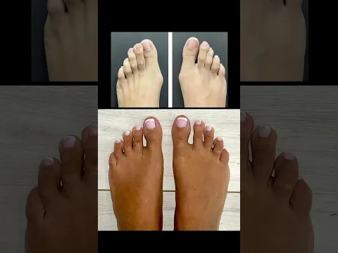YUP, WE MAKE BEAUTIFUL FEET🌈#shorts #footsurgery #footfeminization