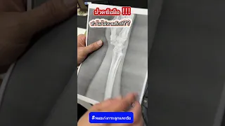  ทำไมข้อมือถึงบวมและปวดซ้ำ ๆ โดยเฉพาะเมื่อใช้งาน 