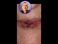 Download Lagu From Fall to Flawless: Broken Tooth Replacement