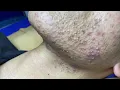 Lagu Best Pimple Popping P1 | Mụn Dậy Thì Siêu Hấp Dẫn P1 - SacDepSpa#181