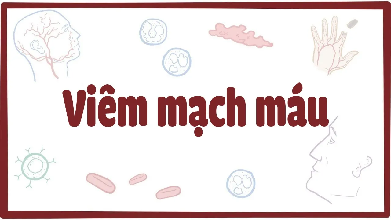 Outline Video Viêm mạch máu