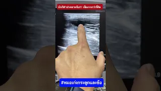  อาการบวมที่ขาหนีบของนักฟุตบอลที่เกิดจากการสไลด์บอล มีสาเหตุมาจากอะไร 