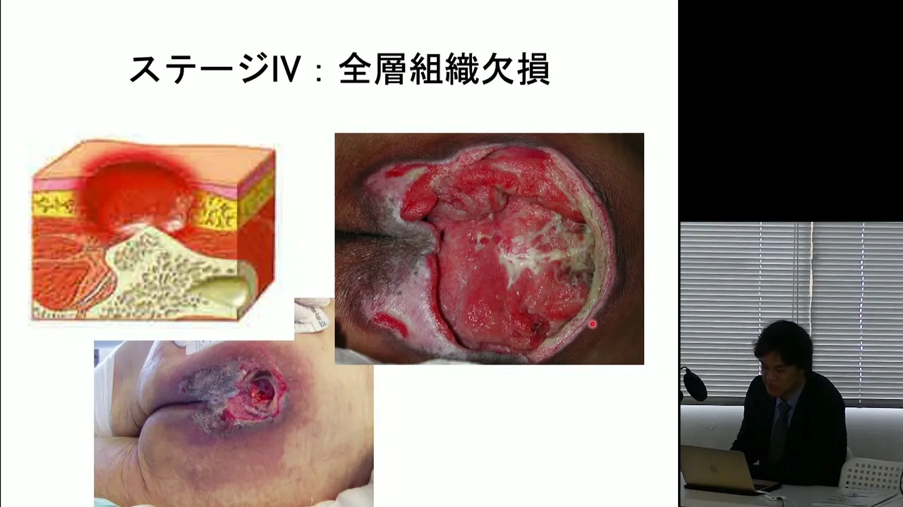 2019年11月24日 #579 『看護師のための創傷(創傷、褥瘡、熱傷)治療Up-to-Date-適切な局所治療の選択を』(前川武雄先生)