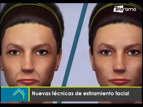 Estética al Día: Nuevas técnicas de estiramiento facial