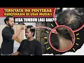 Download Lagu Masih Muda Kok Rambut Mulai TIPIS? Begini Cara Mengatasinya…