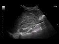 Download Lagu Case 259: Penetrating Abdominal Trauma with Shock – FAST Revealed Echogenic Free Fluid