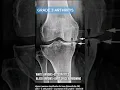 How Severe Is Your Knee Arthritis