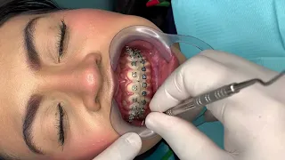 🔥Quitando Alambres y Elásticos de los Brackets de Metal🔥
