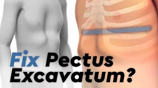 Pectus Excavatum And The Nuss Procedure 