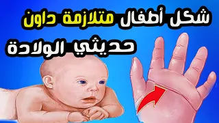 شكل أطفال متلازمة داون حديثي الولادة 