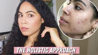 WHAT YOUR CHEEK ACNE IS TRYING TO TELL YOU
