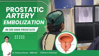 Prostatic Artery Embolization in 120 gms prostate.