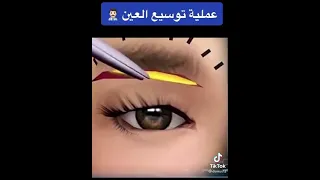 شاهد عملية توسيع العين ارتخاء الجفن بشكل مبسط 