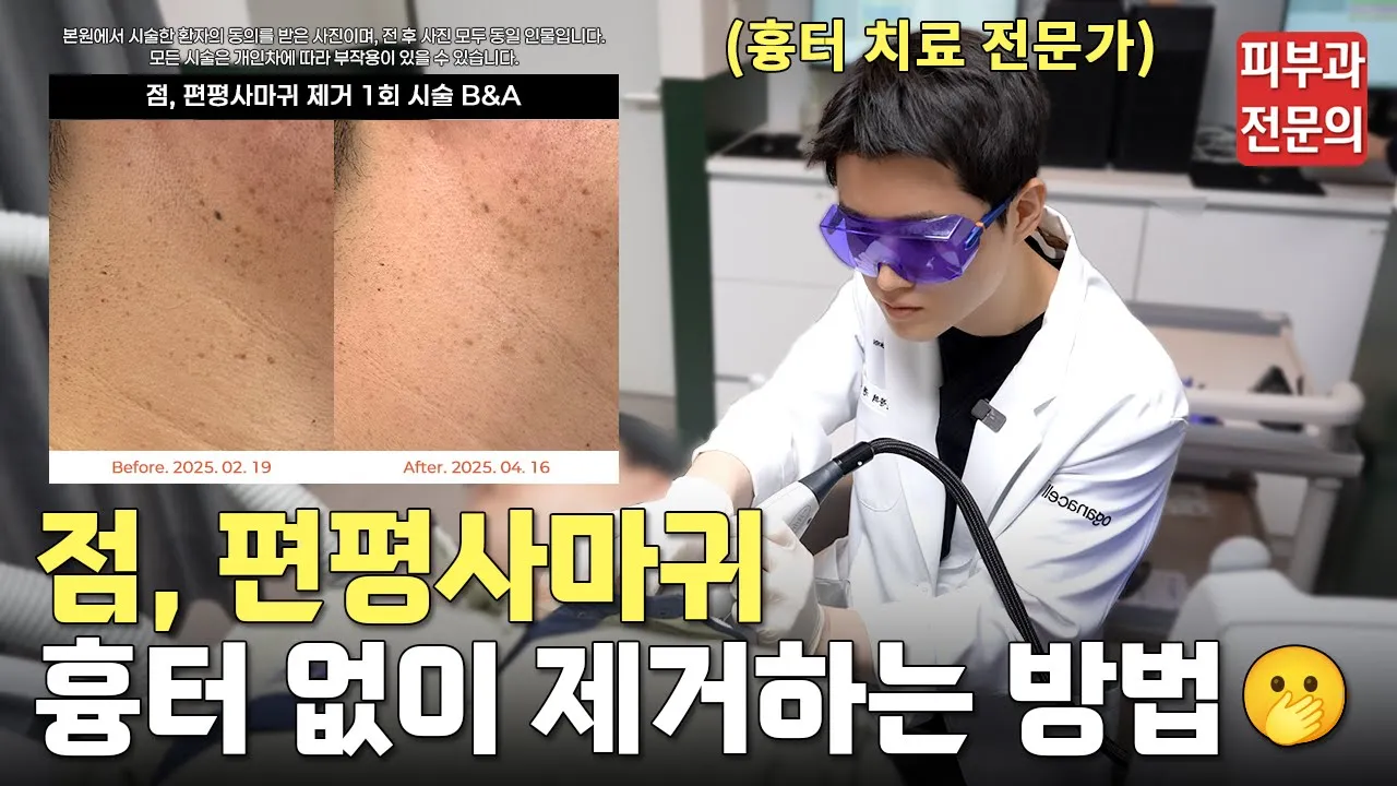 흉터 없이 편평사마귀, 점 없애는 방법 최초 공개!ㅣ점 없애는 법, 점 빼고 관리, 점 빼는 영상, 점 빼고 후기, 편평사마귀 제거, 편평사마귀 레이저, 편평사마귀 제거 후기