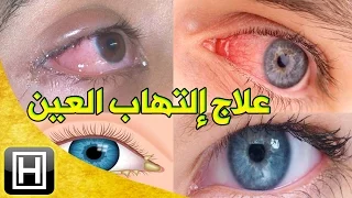 علاج إلتهاب العيون طبيعيا والتخلص من العمش وإحمرار العين في المنزل بأرخص وأسهل طريقة 