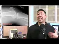 How to Identify Knee Effusions on a Lateral Knee X Ray
