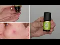 Can you apply Tea Tree Oil directly to Acne Pimple - Here is what happened to me
