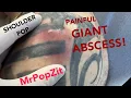 A VERY POPPY deep shoulder abscess drained Put on your raincoat and come check it out