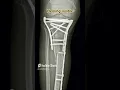 Download Lagu Dual Plating proximal tibia fracture #ortho #trauma #education