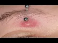 how to get rid of keloids on eyebrow piercing