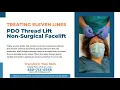 Treating eleven lines PDO Treating Face Lift Dr K Med Spa - Fountain Hills AZ