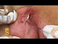 Pimples Behind The Ears Noi Mun Sau Tai - SacDepSpa