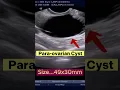 Download Lagu Ultrasound Para Ovarian Cyst