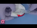 Fabricating a Provisional Under a Removable Appliance