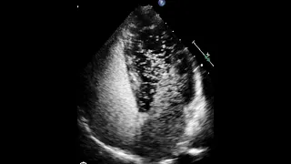 Bubble study in echocardiography intra vs extra cardiac shunts in bubble study