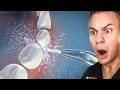 How Cheap Water Flossers Can DAMAGE Your Tonsils