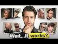 BEST Hair Regrowth Stories of This Year No Hair Transplant