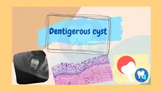 Dentigerous Cyst Oral pathology Dental lectures