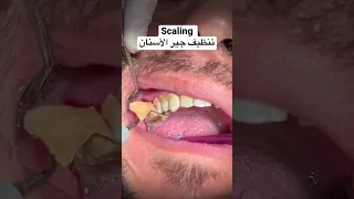 تنظيف جير الأسنان Scaling Gülüşestetiği Hollywood Smile ابتسامة ابتسامة هوليوود تنظيف الاسنان 