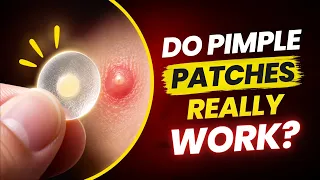 Pimple Patches: When They Work & When They Don’t! | Clear Skin Clinic, Pune