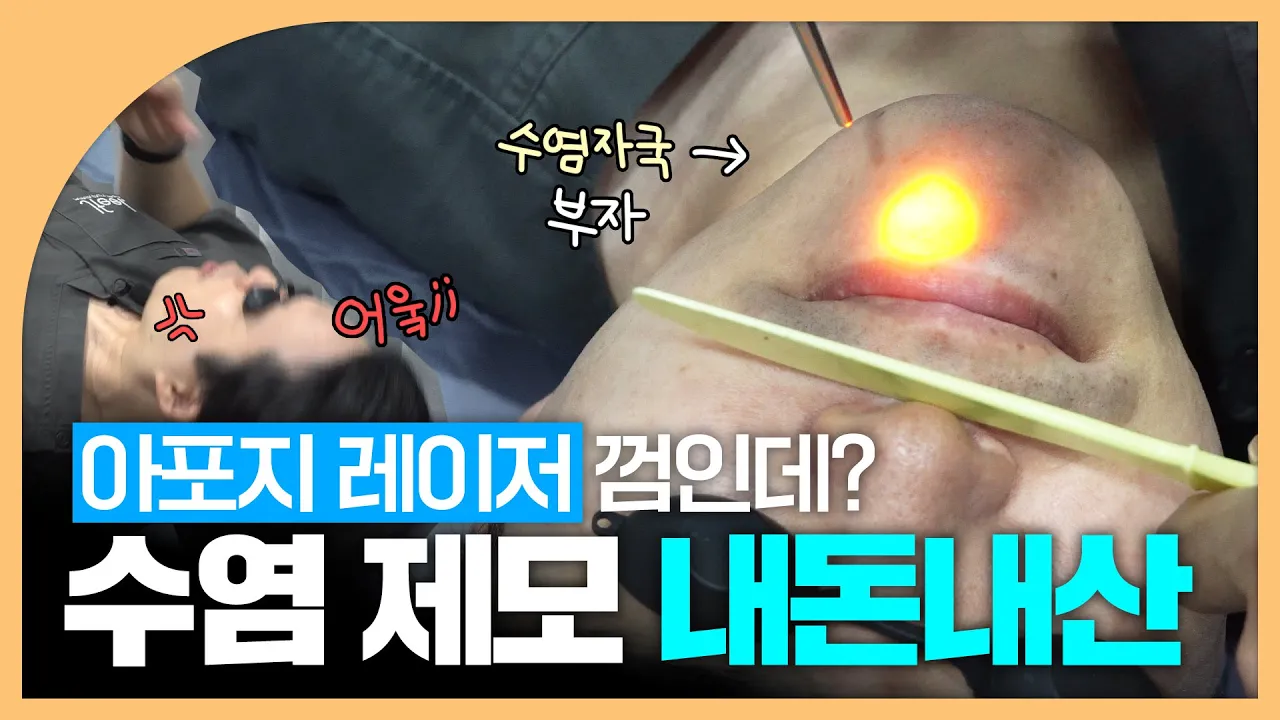 통증 탑티어 수염 레이저 제모 별로 안 아ㅍ...｜의사의 내돈내산 💸