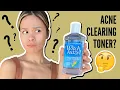 Witch Hazel for Acne Good Or Bad Get The Facts