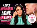 Adult Hormonal Acne 7 Signs Your Breakouts Are Hormone-Driven