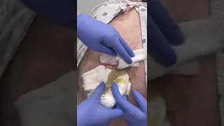 Massive Abscess Removal On Back 