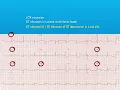 Lateral STEMI
