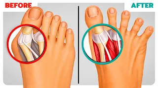 The Man Who Refused Bunion Surgery (what he did instead)
