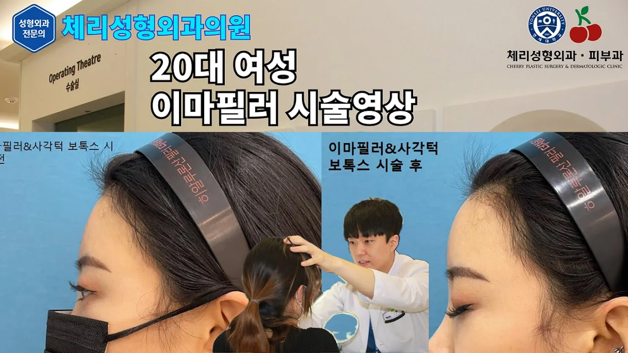 [체리성형외과피부과] 이마필러 시술 영상 / Forehead filler