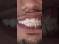 Lateral Incisor Missing - Fixed